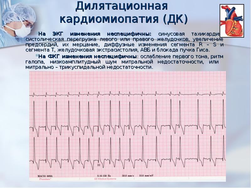 Экг при дилатационной кардиомиопатии фото