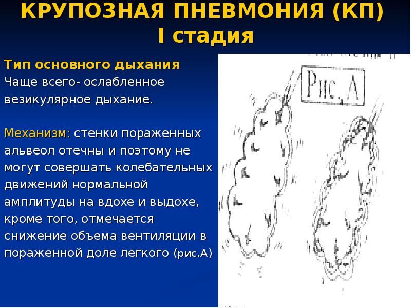 Наиболее возможная аускультативная картина легких при очаговой пневмонии