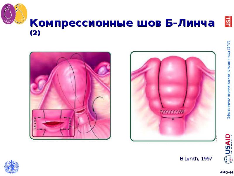 Презентация на тему акушерское кровотечение