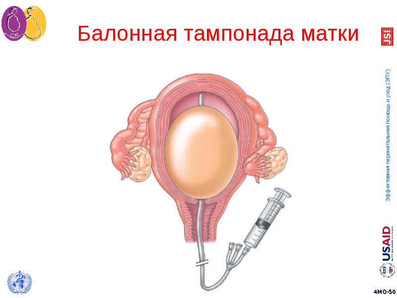 Баллонная тампонада матки презентация