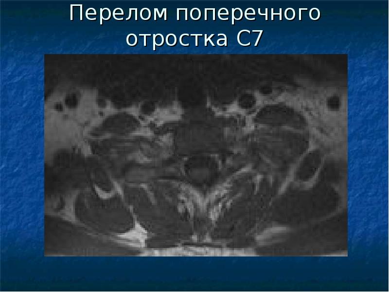 Перелом отростка l2. Перелом правого поперечного отростка l1. консолидированный перелом поперечного отростка l1 слева. переломы поперечных отростков позвонков. перелом поперечных отростков л3 л 4.