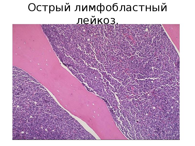 Лейкозы презентация патанатомия