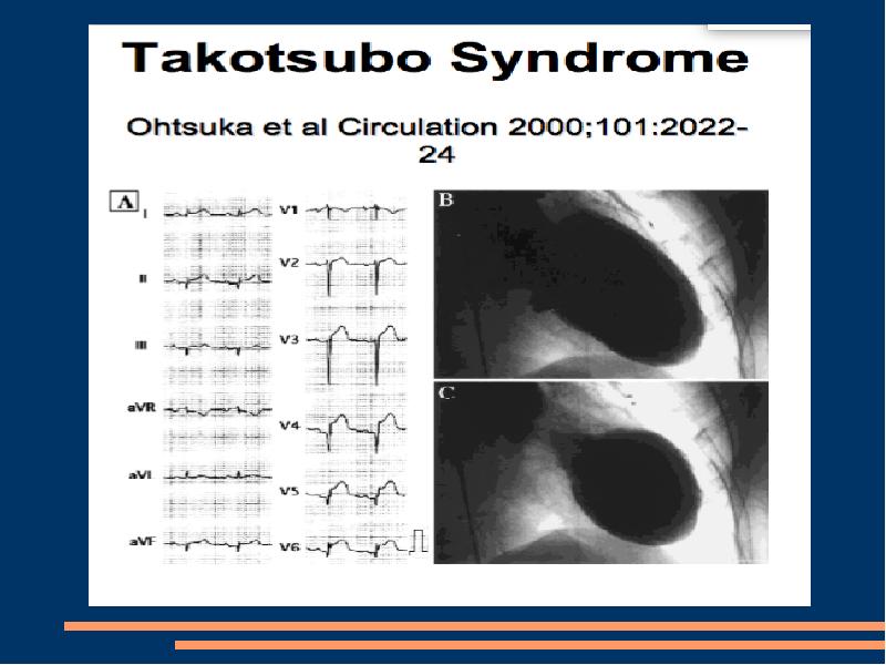 Кардиомиопатия такоцубо презентация