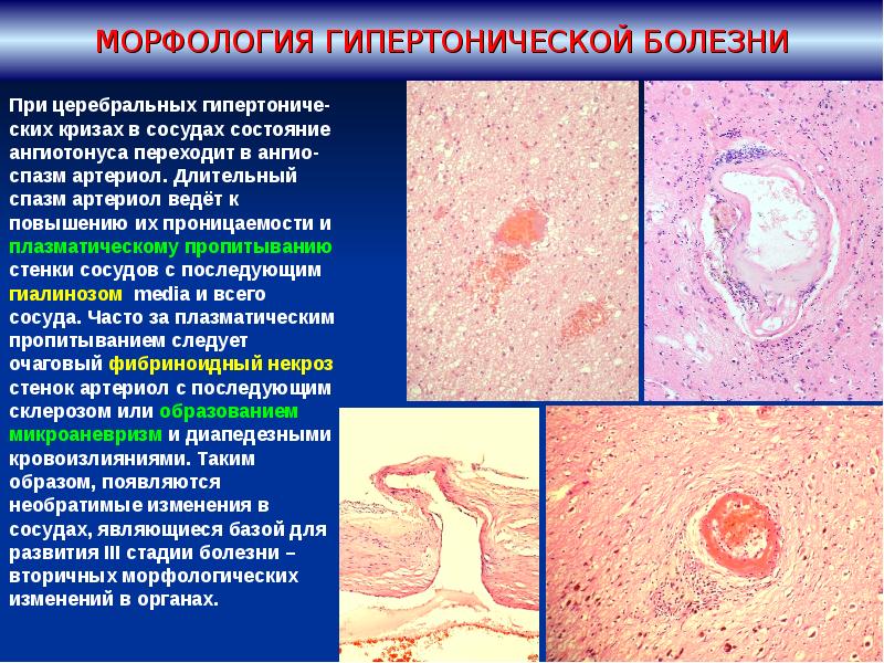 Патанатомия гипертоническая болезнь презентация