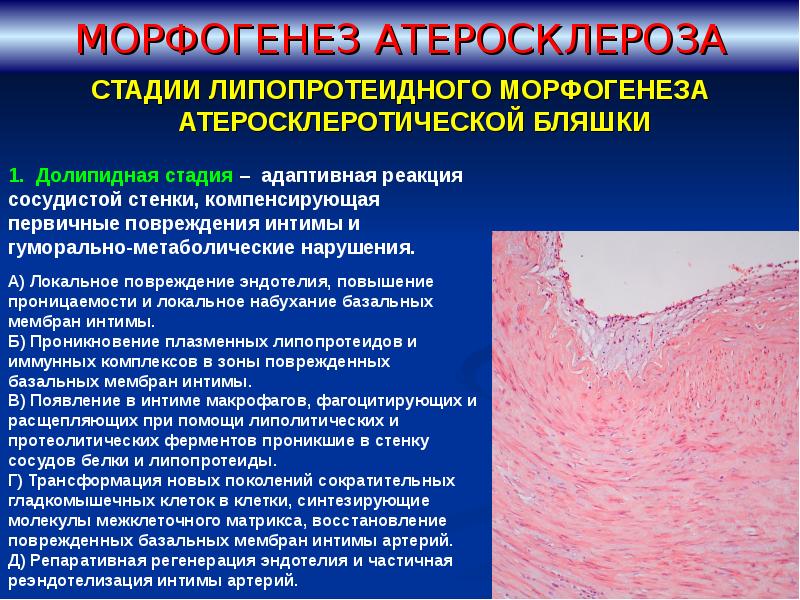 Схема тромбоза при атеросклерозе мозговых артерий