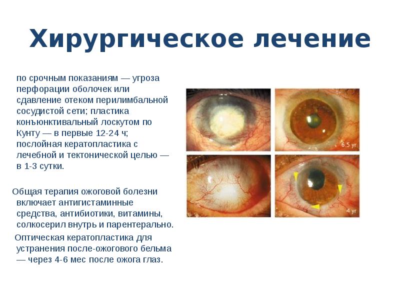 Презентация ожоги глаз и их виды