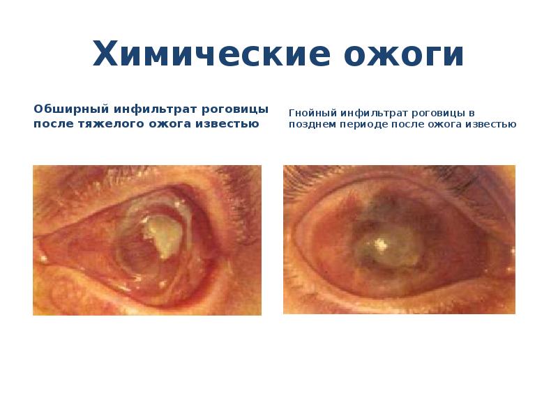 Презентация на тему ожог глаз