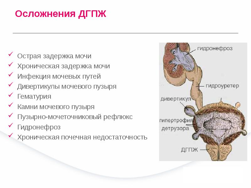 Железисто стромальная гиперплазия предстательной железы на фоне хронического простатита
