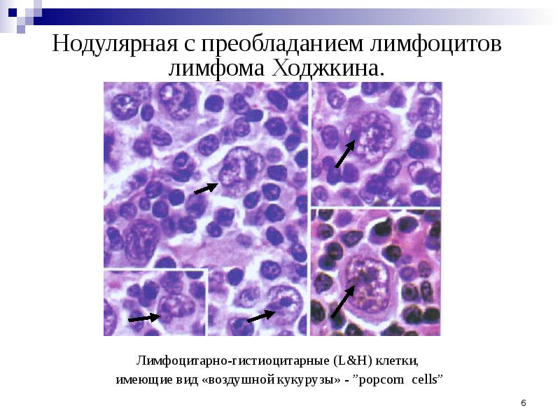 Что такое лимфома ходжкина фото