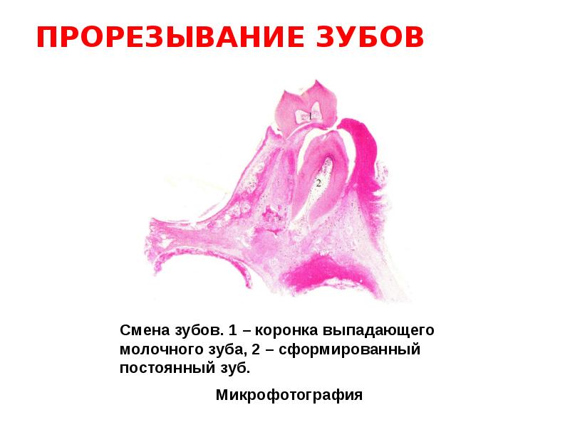 Болезни прорезывания зубов презентация