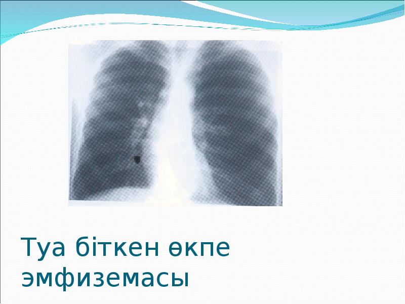 Туа біткен өкпе эмфиземасы Туа біткен өкпе эмфиземасы