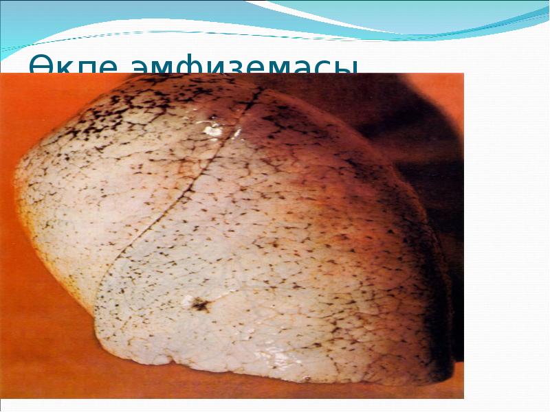 Өкпе эмфиземасы Өкпе эмфиземасы