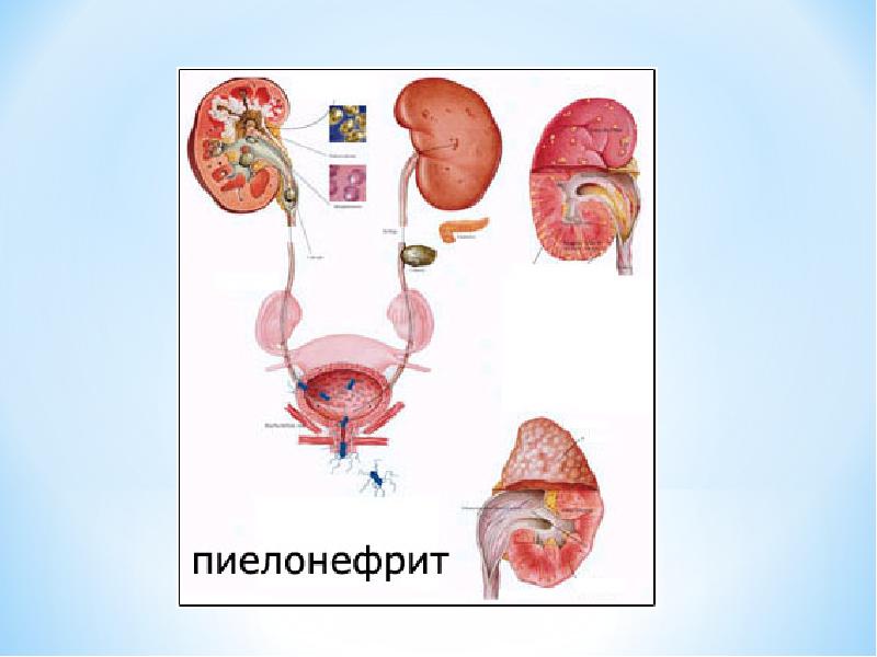 Созылмалы жүрек жетіспеушілігі презентация