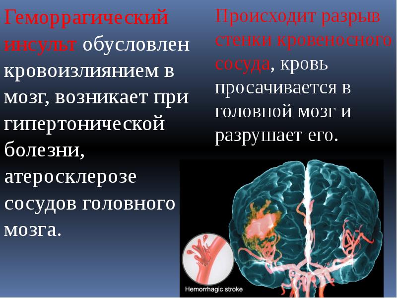 Сосуды головного мозга сужены симптомы. Инсульт презентация для школьников. Инсульт определение.