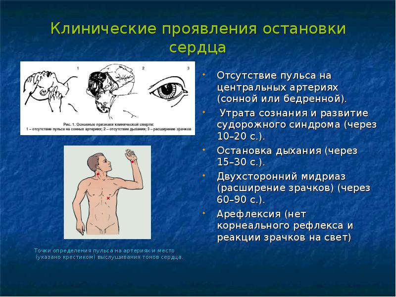 Признаком остановки сердца не является. Признаки остановки сердца. Отсутствие пульса на сонной артерии. Отсутствие сердцебиения. Точки определения пульса.