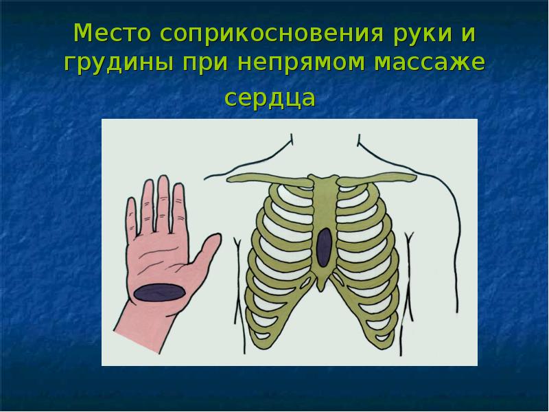 Руки при непрямом массаже сердца. Место соприкосновения руки и грудины при непрямом массаже сердца. Место расположения ладоней при непрямом массаже сердца. Расположение рук на груди при непрямом массаже сердца. Место соприкосновения руки и грудины.