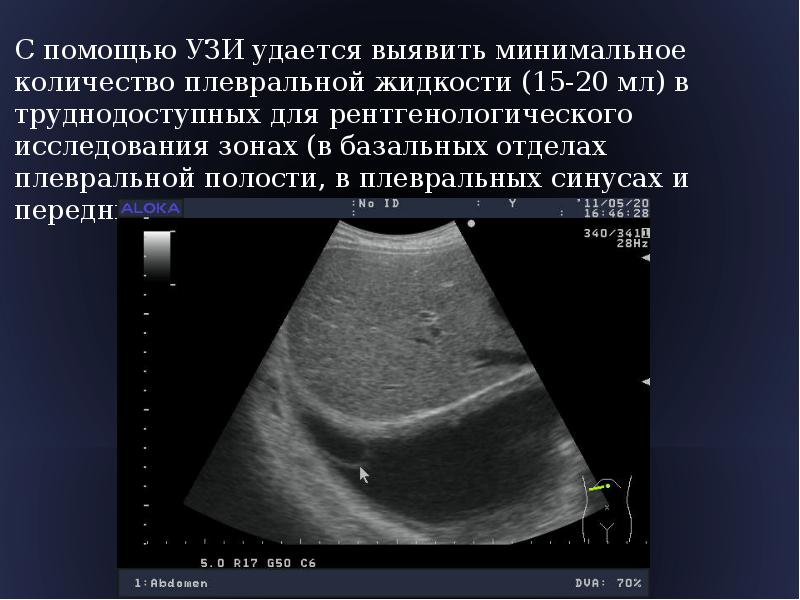 Узи плевральной полости. УЗИ плевральных полостей плеврит. Гидроторакс УЗИ плевральных полостей. Плевральный выпот на УЗИ. УЗИ плевральных полостей протокол.