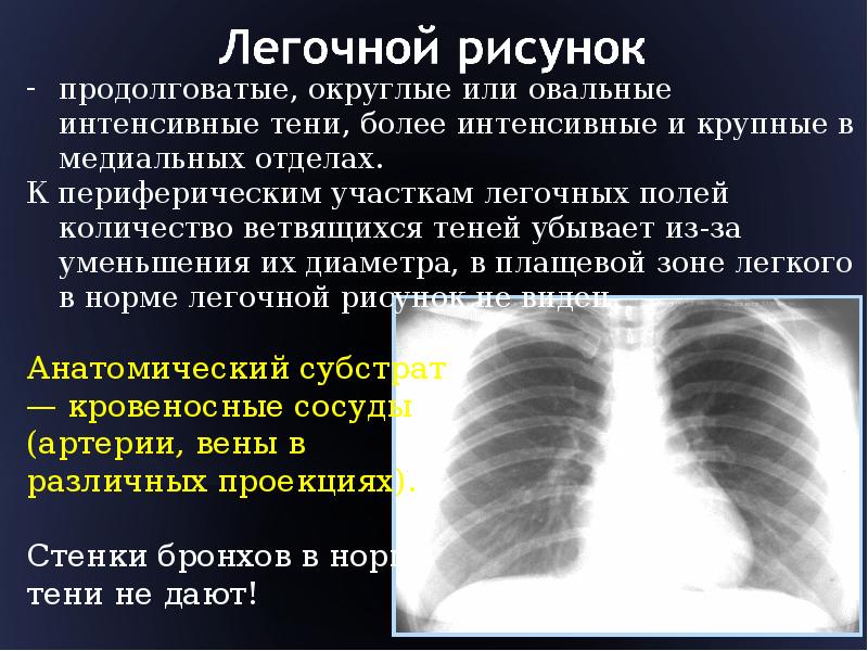 Признаки усиления легочного рисунка. Анализ легочного рисунка. Легочный рисунок усилен. Легочный рисунок обогащен. Нормальный легочный рисунок.