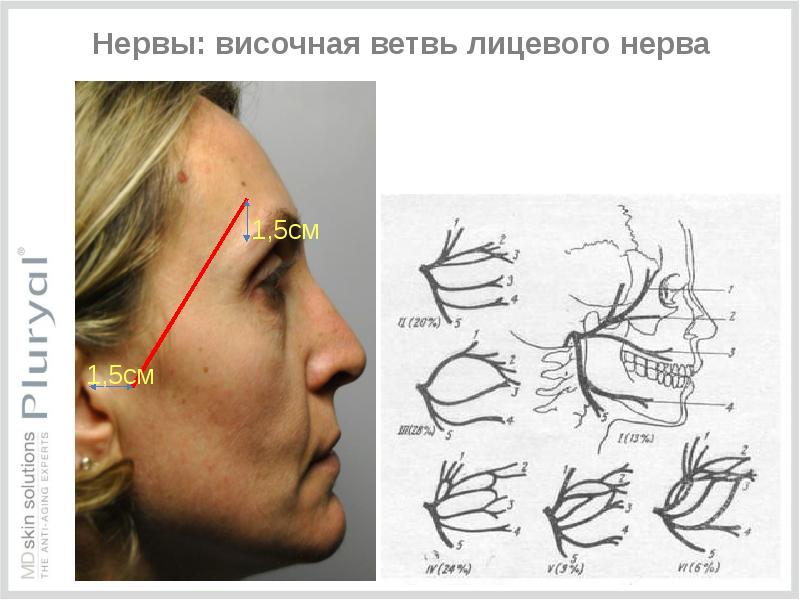 Разметка по ландау скулы схема