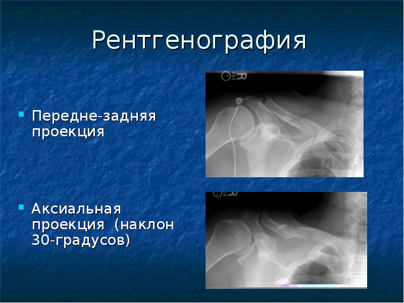 Ключица укладка. Перелом ключицы рентгенография. Рентген ключицы укладка в двух проекциях. Рентген ключицы в аксиальной проекции.