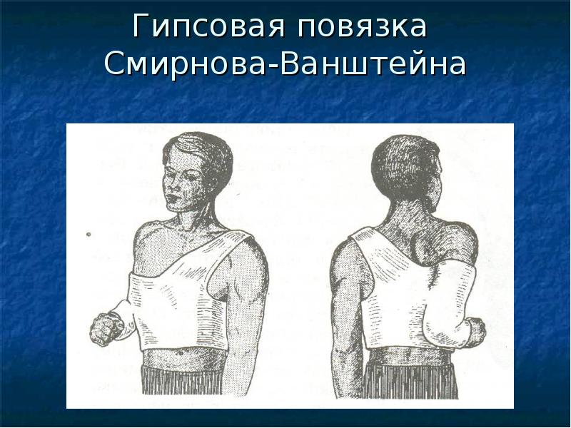 Перелом ключицы презентация