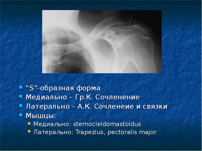 Перелом ключицы презентация