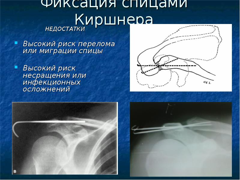 Переломы ключицы презентация