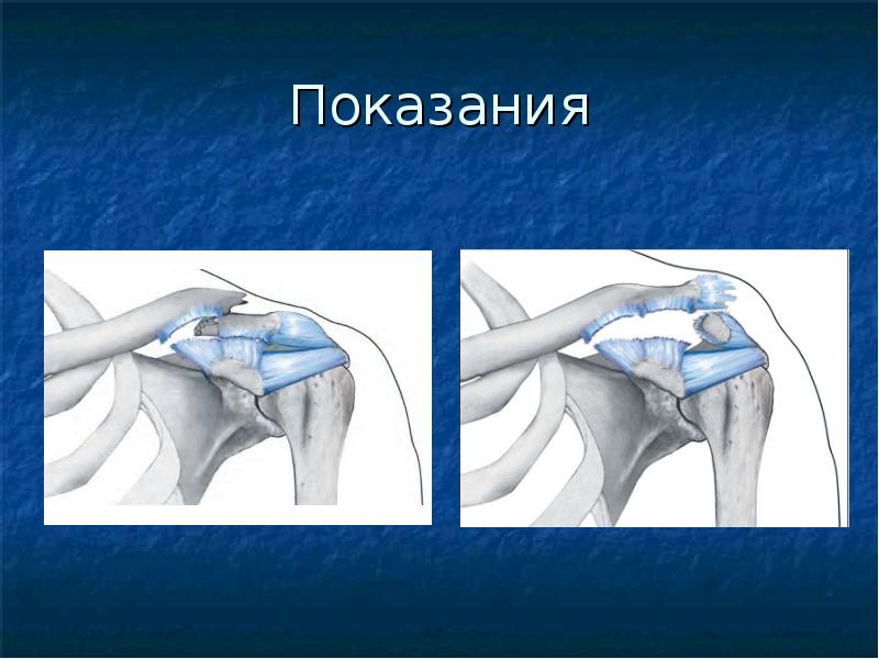 Переломы ключицы презентация