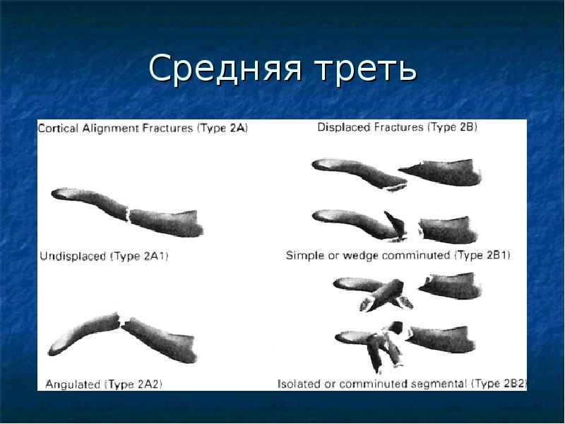 Ключица классификация