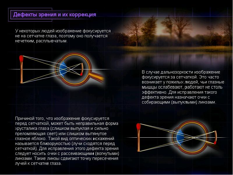 Изображение фокусируется перед сетчаткой это