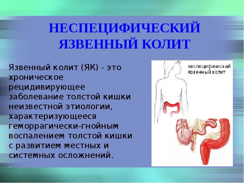 Язвенный колит терапия презентация