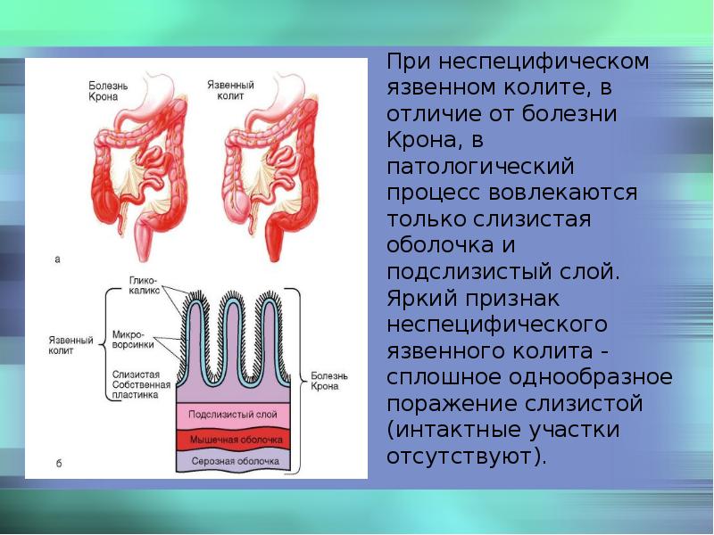 Язвенный колит мкб. Неспецифический язвенный колит и болезнь крона. Болезнь крона презентация. Неспецифический язвенный колит презентация.