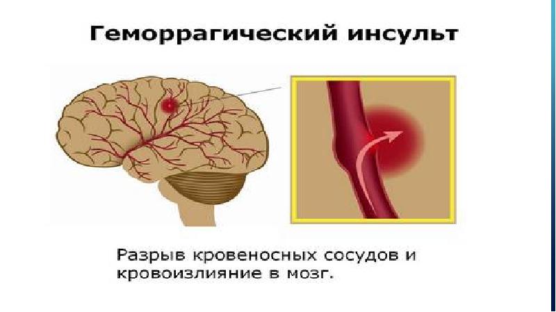 Инсульт картинки мультяшные