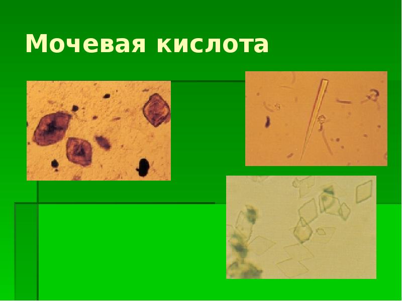 Ураты и мочевая кислота