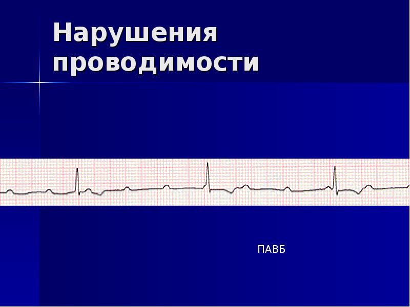 Нарушения проводимости презентация