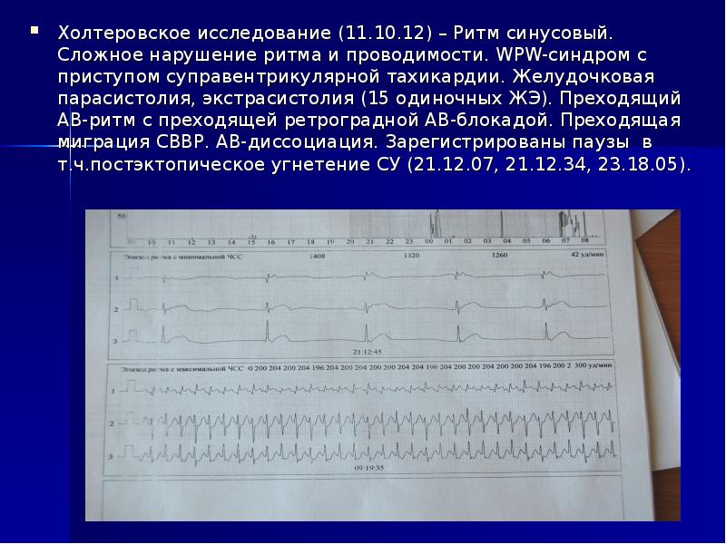 Нарушение ритма по типу бигеминии карта вызова