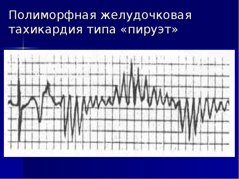 Нарушение ритма у детей презентация