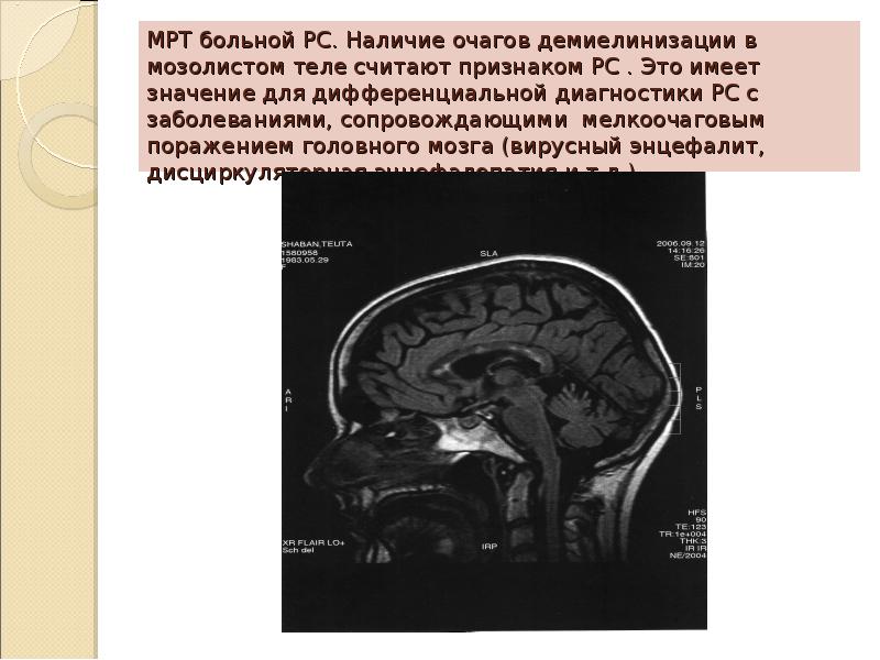 Презентация на тему рассеянный склероз