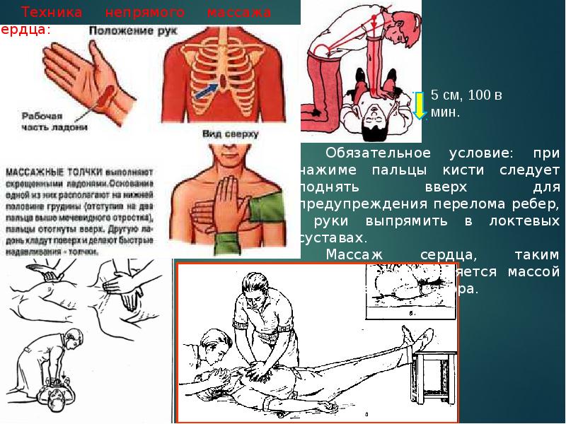 Первая медицинская помощь при отсутствии дыхания. Первая помощь при остановке дыхания и кровообращения. Оказание первой помощи при отсутствии кровообращения. Оказание первой помощи при остановке кровообращения. Первая помощь при остановке кровообращения алгоритм.