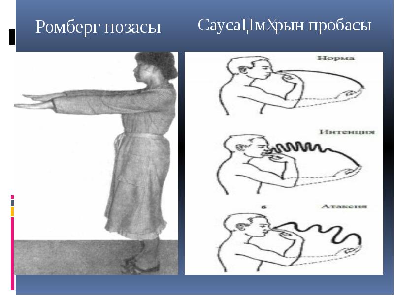 Поза ромберга что. Поза ромберга. Проба ромберга. Поза ромберга пошатывание. Атаксия в позе ромберга.
