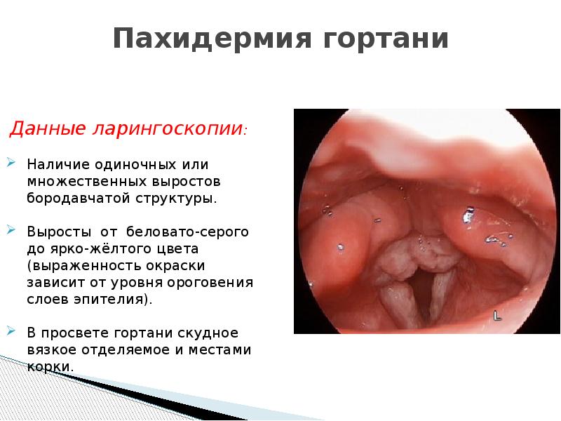 Презентация на тему ларингит