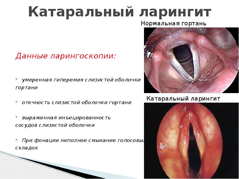 Презентация на тему ларингит