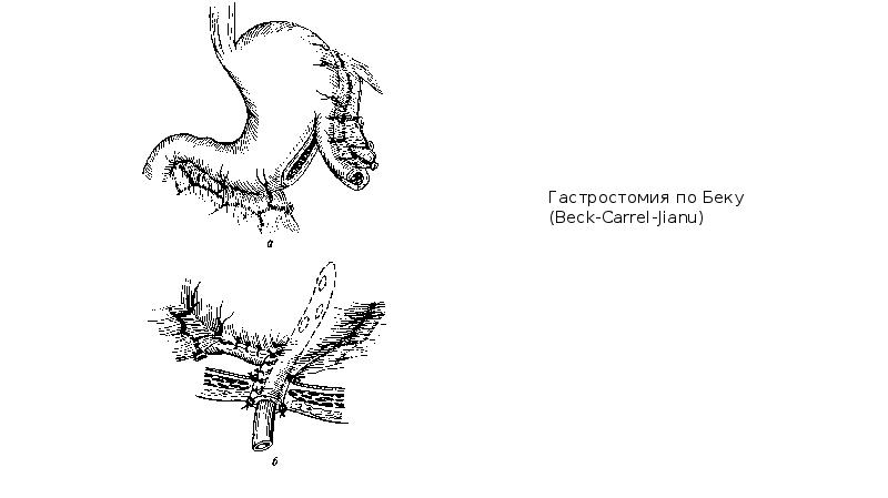 Гастростомия по витцелю схема