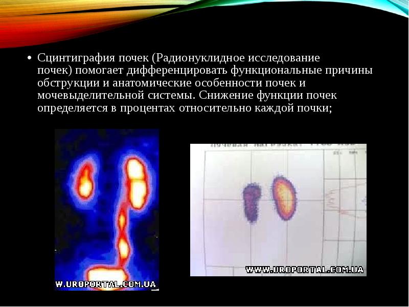 Что такое сцинтиграфия