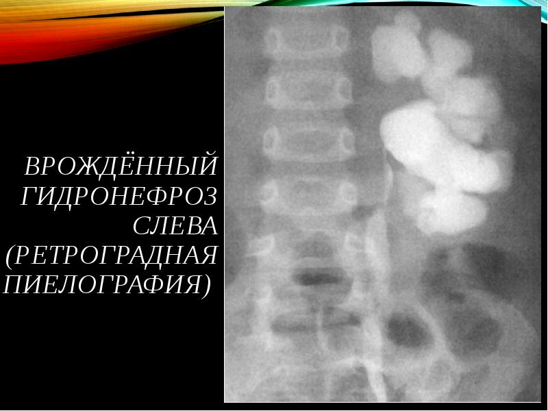 Гидронефроз презентация детская хирургия