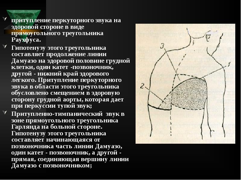 притупление перкуторного звука на здоровой стороне в виде прямоугольного треугольника Раухфуса. притупление перкуторного звука на здоровой стороне в виде прямоугольного треугольника Раухфуса.