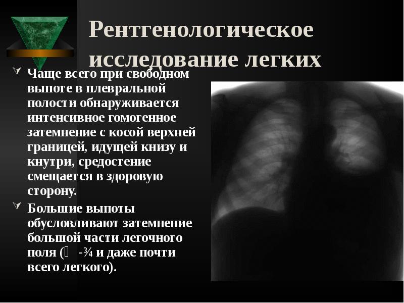 Рентгенологическое исследование легких
Чаще всего при свободном выпоте в плевральной Рентгенологическое исследование легких
Чаще всего при свободном выпоте в плевральной