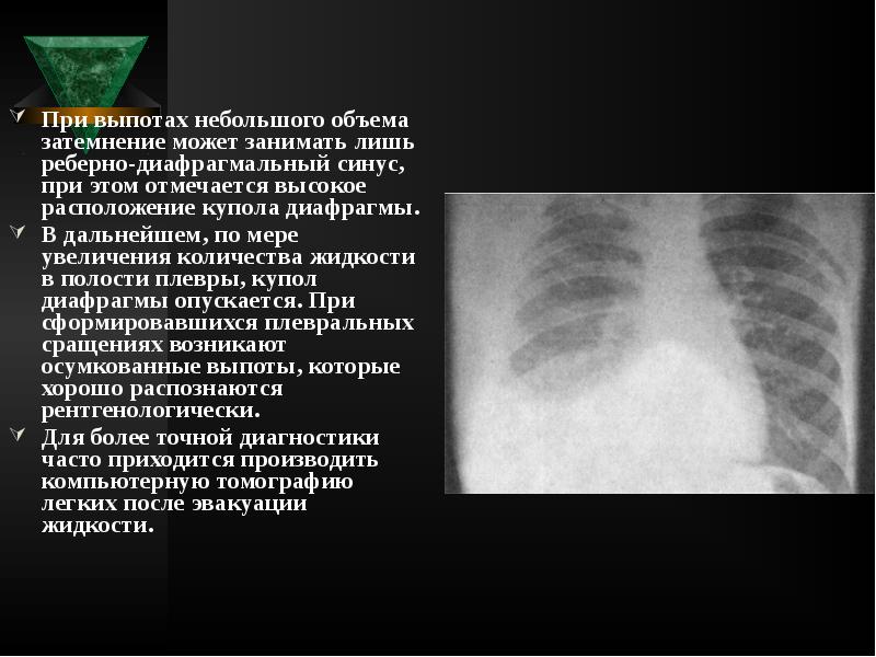 При выпотах небольшого объема затемнение может занимать лишь реберно-диафрагмальный синус, при При выпотах небольшого объема затемнение может занимать лишь реберно-диафрагмальный синус, при