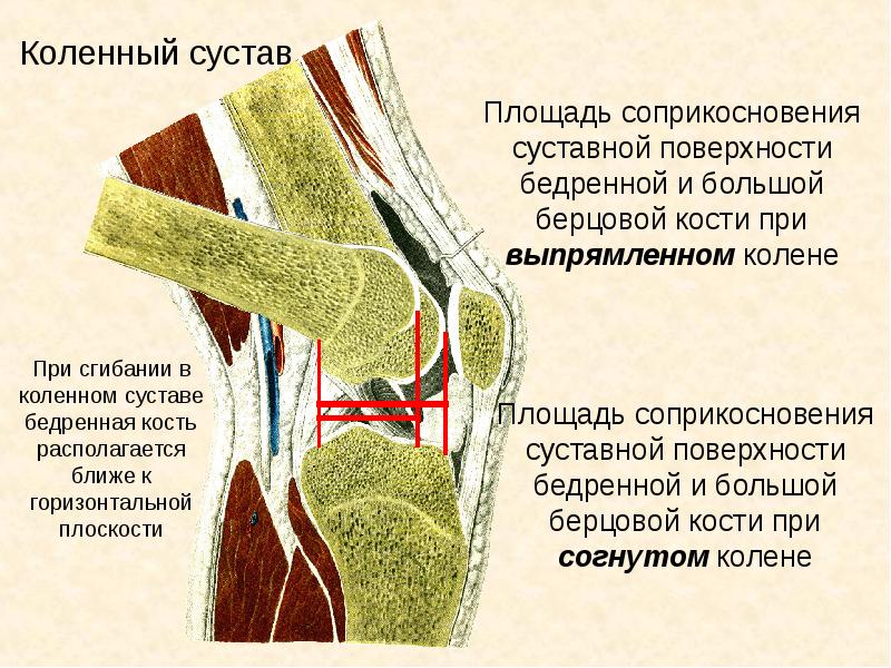 Болезнь гоффа презентация