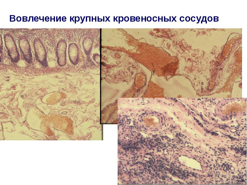 Язвенный колит и болезнь крона презентация